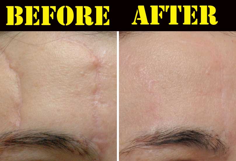 Silicone Sheets For Scars Before And After